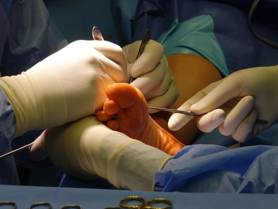 Cirurgia percutânea de deformidade dos dedos do pé